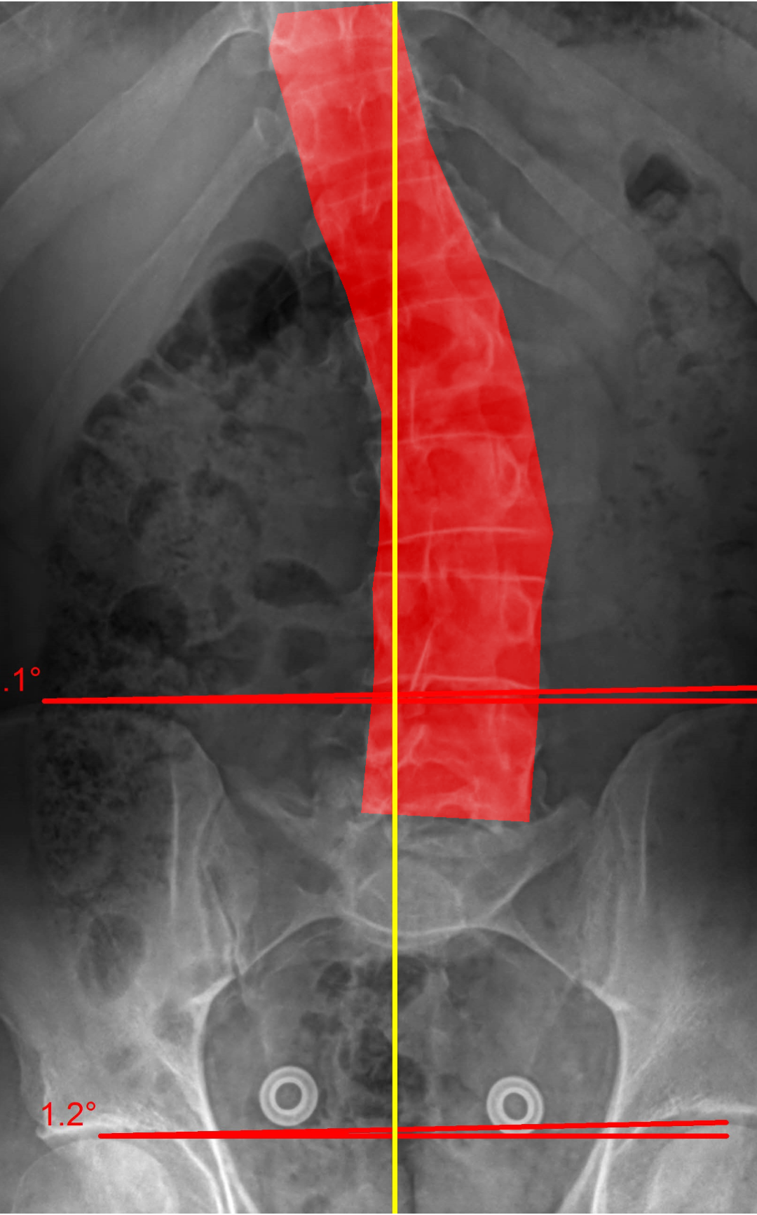 X-ray of Adam's spine with the scoliosis curve highlighted in red